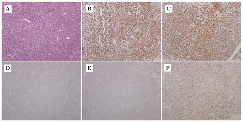 Figure 1 From Primary Testicular Lymphoma With Subcutaneous Masses As