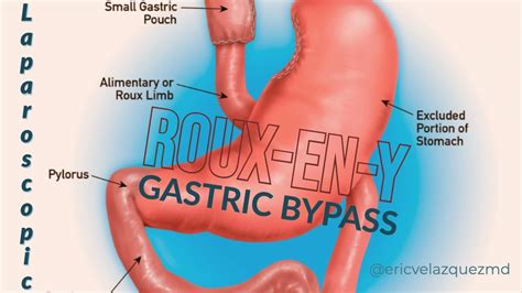 Laparoscopic Roux En Y Gastric Bypass Basicmedical Key My Xxx Hot Girl