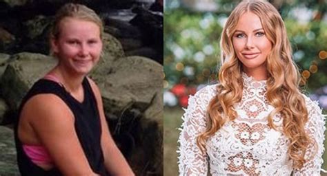 The Bachelor Australia 2019 Before And After Surgery Photos Who Magazine