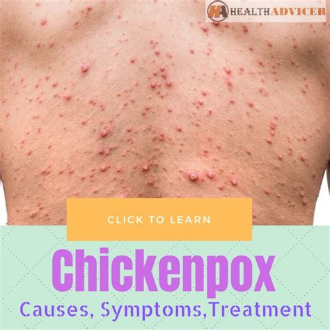 Chickenpox Causes Picture Symptoms And Treatment