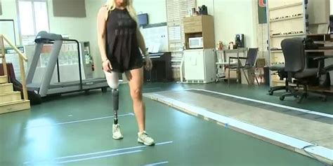 your health powered prosthetics for amputees