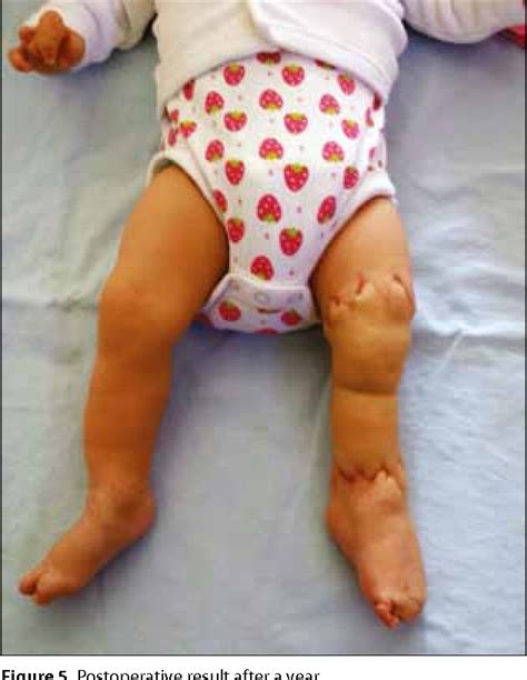 Figure 1 From Single Stage Surgical Treatment Of Amniotic Band Syndrome