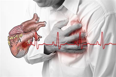 How To Code Some Common Cardiac Conditions Cardiology Coding