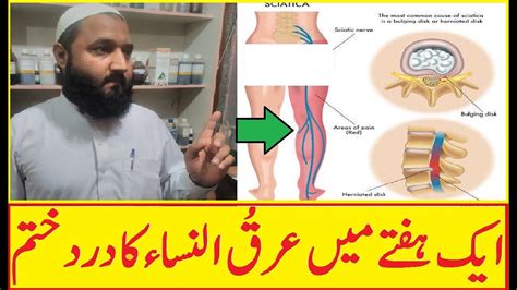 Sciatica Causes And Treatment In Urdu YouTube