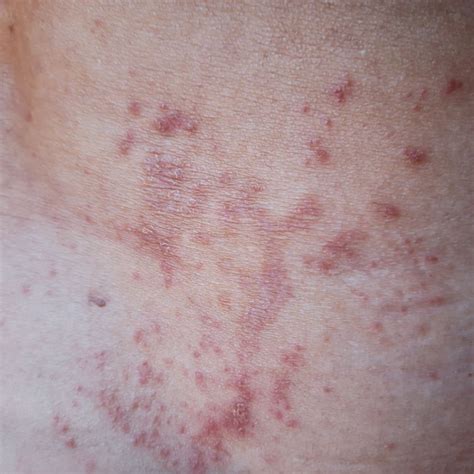 Hidradenitis Suppurativa Stage 3 Hurley Stage 3 Pictures And