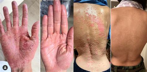 Is Psoriasis Curable Hanna Sillitoe