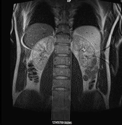 Lower Back Pain Mri Scans Help