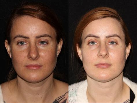 Bbl Photofacial Before And After Photo Gallery Chico Yuba City Oroville Ca Hodari Md