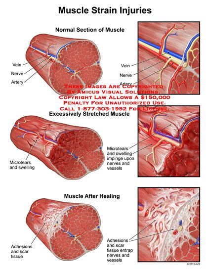 Muscle Knot Anatomy