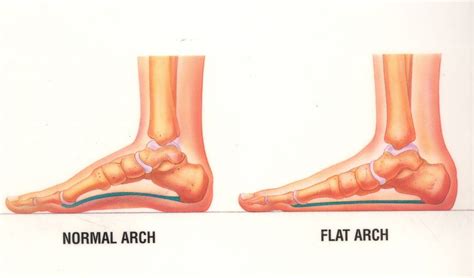 Flat Foot Pes Planus Caribbean Orthopaedic