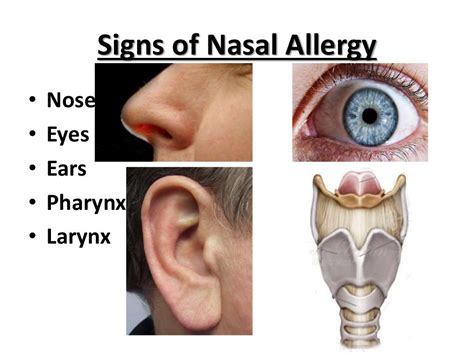 Nasal Allergy