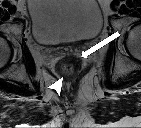 Mri Of Rectal Cancer Tumor Staging Imaging Techniques And Management