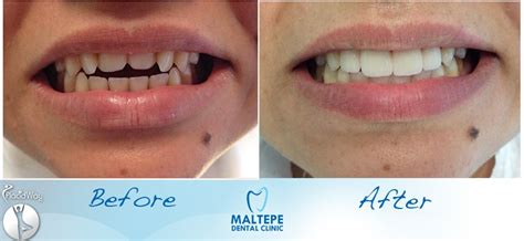 Dental Veneers Before And After Pictures Turkey Dentistry Istanbul