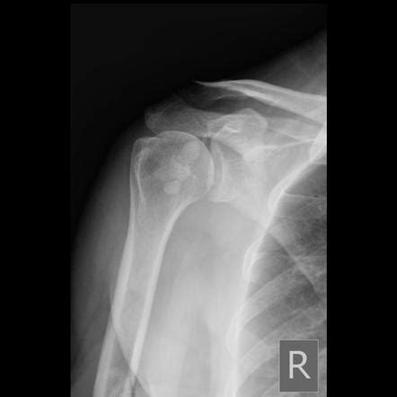 Calcification In The Supraspinatus Tendon Radiology Case