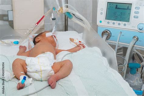 Newborn Baby With Hyperbilirubinemia On Breathing Machine Or Ventilator