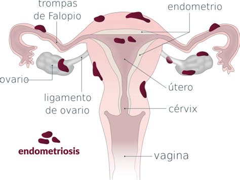Endometriosis Diagnóstico Y Tratamiento De Una Enfermedad Silenciosa