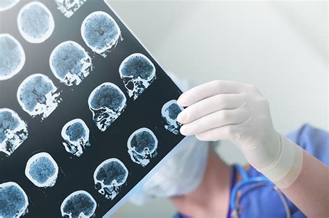Tomografía computarizada puede eliminar necesidad de una biopsia