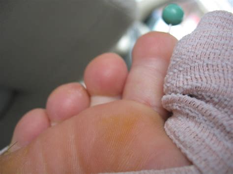 The Back Of My Second Toe Is Swollen Flickr Photo Sharing