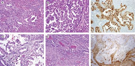classification of endometrial carcinoma more than two types the lancet oncology
