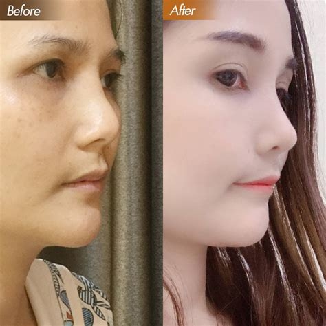 รีวิวแก้จมูก อัพเดท 2 เดือน คุณแพร โดยคุณหมอตุ๊ก ปาลิดา Dmor Clinic