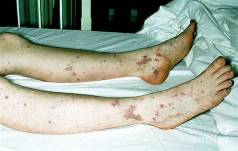 Patient Legs With Bacterial Septiceamia Photograph By John Radcliffe
