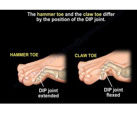 Claw Toe And Hammer Toe —