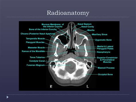 Ppt Imaging Of Nasopharyngeal Carcinoma Powerpoint Presentation Free