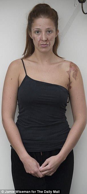 London Nightclub Acid Attack Victim Relives Horror Daily Mail Online