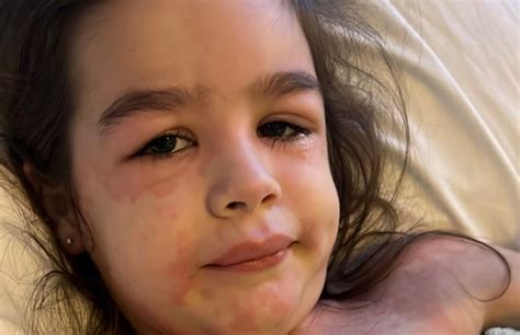 Mum Shares Strep A Warning Signs After Daughter Left Unable To Walk Wtx News