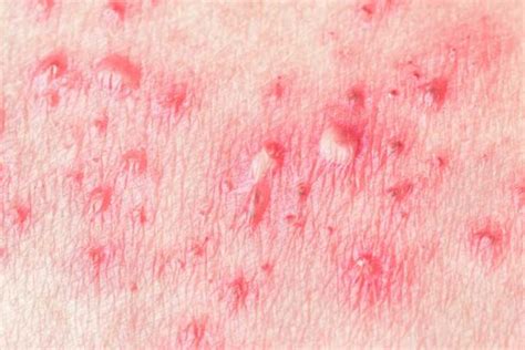 Shingles Everything You Need To Know To Treat It—or To Avoid It