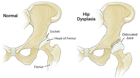 Developmental Dysplasia Of The Hip Causes Symptoms Diagnosis Treatment And Prognosis