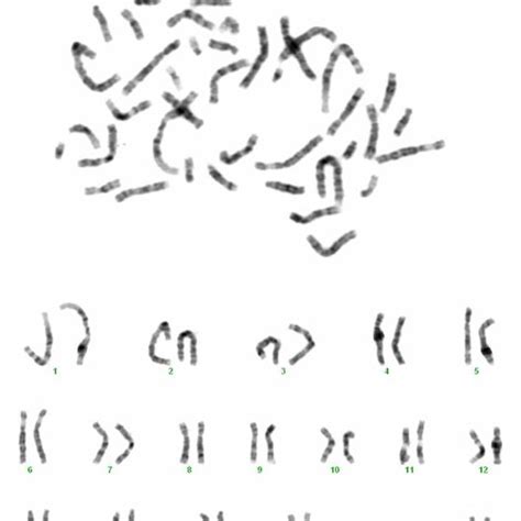 Karyotype Showing The Presence Of An Extra X Chromosome Download