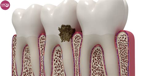 Las Enfermedades Bucodentales Más Comunes Amora Clínica Dental