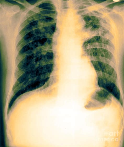 X Ray Of Tuberculosis Photograph By Biophoto Associates Fine Art America
