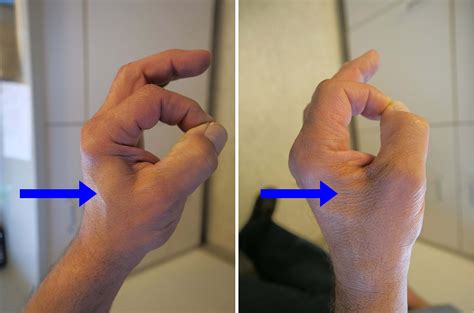 Ulnar nerve entrapment sites around elbow.