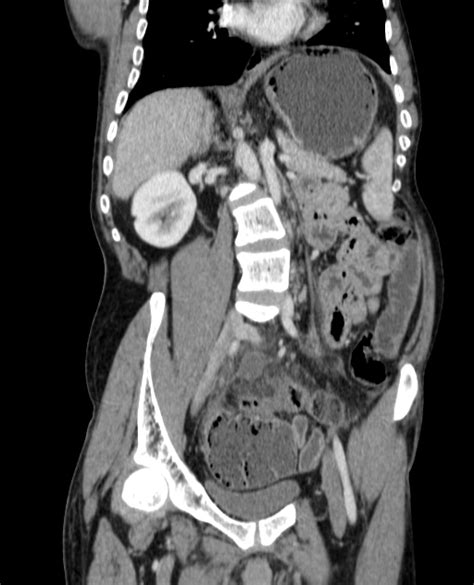 Perforated Appendix Image