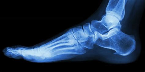 Three Tips To Survive A Foot Stress Fracture Foot Healthcare Associates