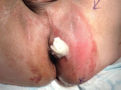 Anal Abscess Drainage Hot Naked Pics Comments