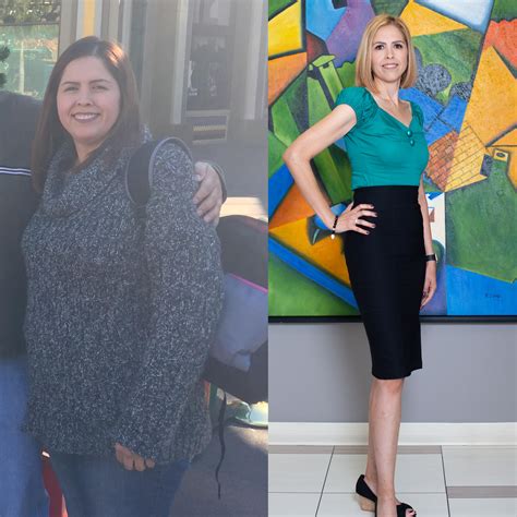 Weight Loss Surgery Before After Photos Soma Bariatrics Los Angeles