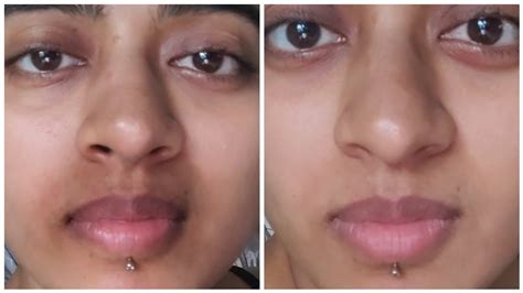 How To Remove Black Spots Around Lips Naturally