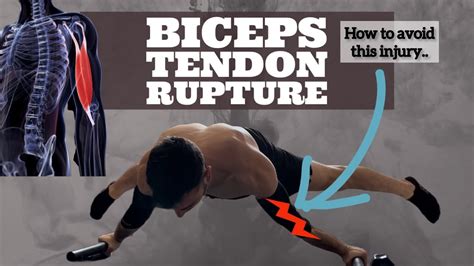 How To Avoid Biceps Tendon Rupture When You Do Planche And Maltese