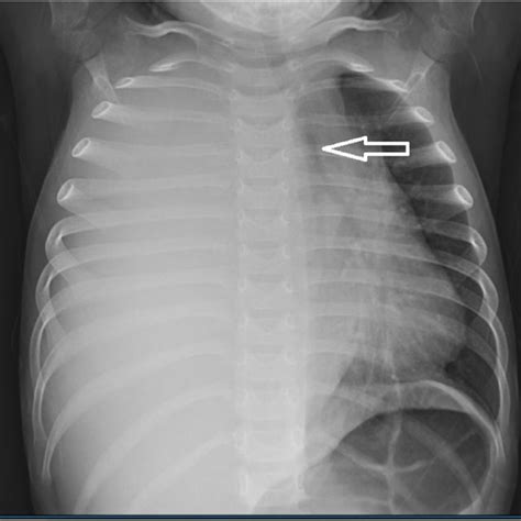 Chest X Ray Showed Complete Opacification Of The Right Hemithorax And