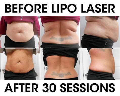 What Is Laser Lipo Before And After