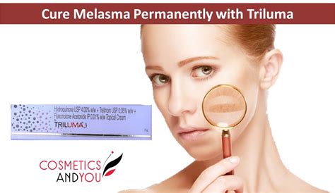 How To Cure Melasma Permanently Cosmetics And You Acne Treatment
