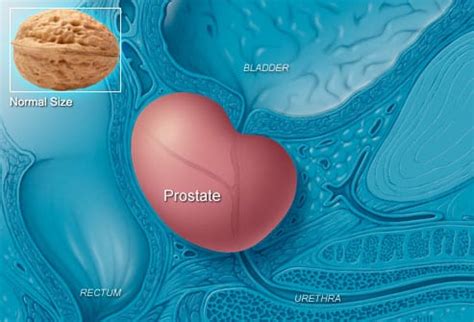 Most men with early prostate cancer don't have any signs or symptoms. Prostate Cancer Testing Making HUGE Strides - CHIPSA ...