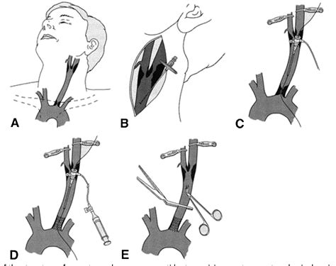 Figure 1 From How Should I Treat A Patient With A Tandem Carotid Artery