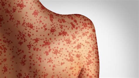 Measles Symptoms First Signs Of Outbreak In Adults And Kids