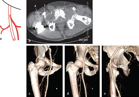 The Profunda Femoris Artery Radiology Key