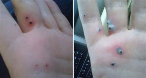 photo black spots appeared on her hand and what came out of them is more than disgusting