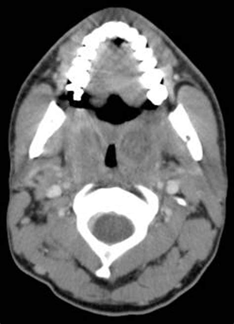 Ct Scan Of Head And Neck Note Tonsillar Swelling Download